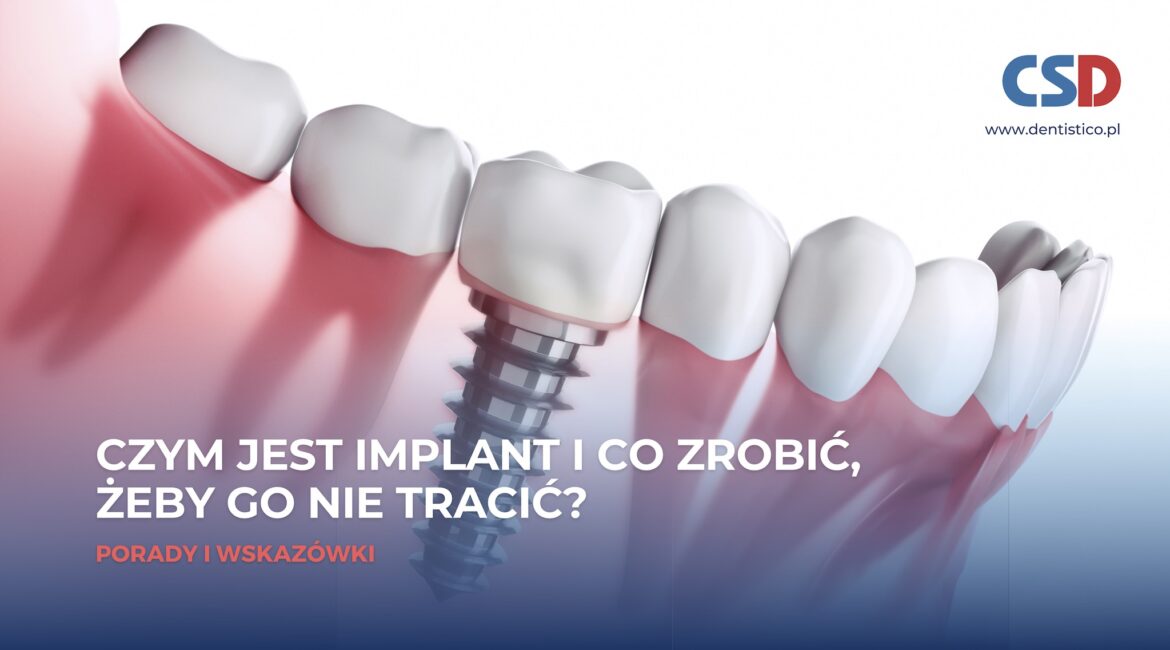 Czym jest implant i co zrobić, żeby go nie stracić?