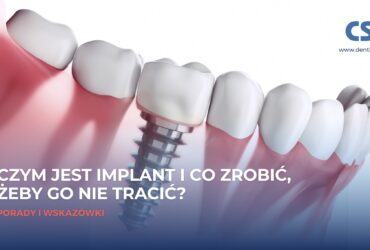 Czym jest implant i co zrobić, żeby go nie stracić?